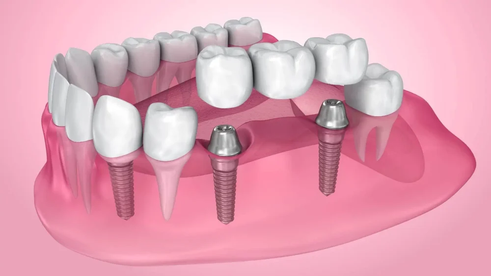 4 λόγοι για τους οποίους τα οδοντικά εμφυτεύματα είναι τόσο επιτυχημένα