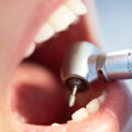 Είναι τα οδοντικά σφραγιστικά αποτελεσματικά κατά της τερηδόνας;