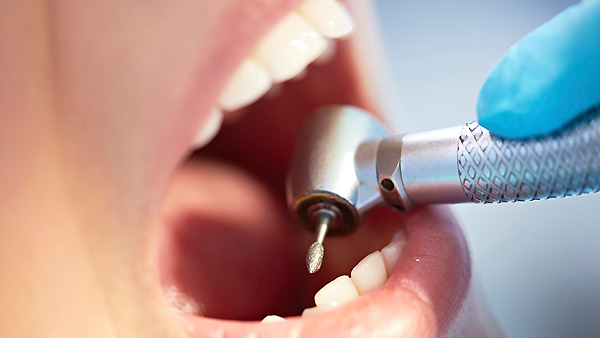 Είναι τα οδοντικά σφραγιστικά αποτελεσματικά κατά της τερηδόνας;