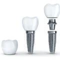 Ποια διαδικασία οδοντικής αποκατάστασης είναι κατάλληλη για εσάς;