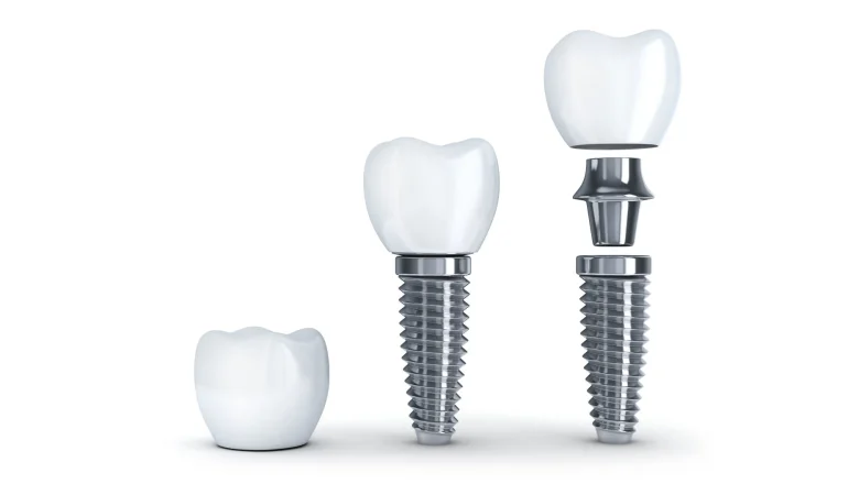 Ποια διαδικασία οδοντικής αποκατάστασης είναι κατάλληλη για εσάς;